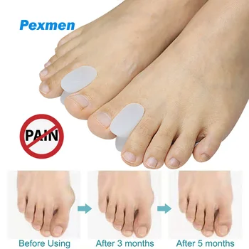 Pexmen 2 шт./пара гелевых разделителей для пальцев ног, прокладок для выравнивания пальцев ног, подушечек для большого пальца стопы, облегчающих боль в большом пальце стопы и предотвращающих натирание пальцев ног.